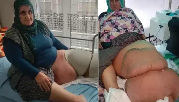 35 yıldır fil hastalığının pençesinde