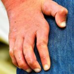 Romanya ve Hırvatistan’da 40 yılın ardından cüzzam vakaları görüldü