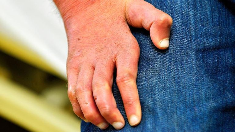 Romanya ve Hırvatistan’da 40 yılın ardından cüzzam vakaları görüldü