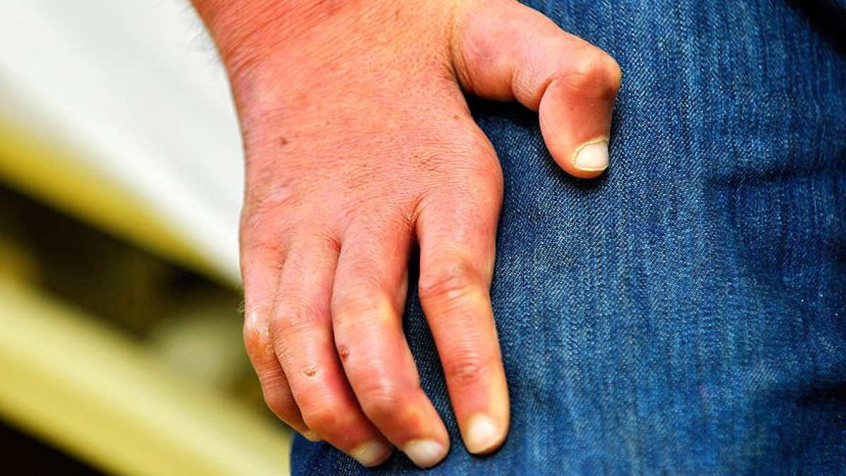 Romanya ve Hırvatistan’da 40 yılın ardından cüzzam vakaları görüldü