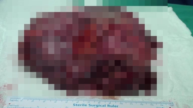 Şanlıurfa’da karın boşluğundan 25 santimlik dev kist çıktı