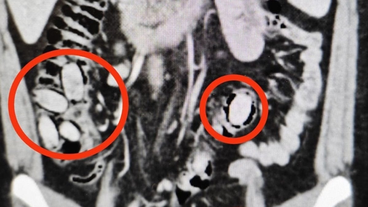 Eskişehir’de midesinde uyuşturucu bulunan şüpheli tutuklandı