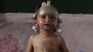 İsrail saldırılarında ağır yaralanan çocuk tedavi bekliyor