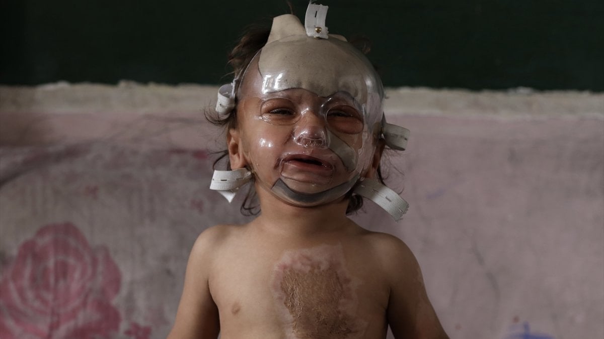 İsrail saldırılarında ağır yaralanan çocuk tedavi bekliyor