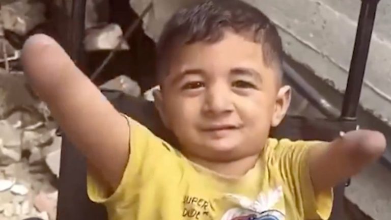 İsrail zulmünün utanç karesi: Gazzeli küçük Amir, uzuvlarını kaybetti