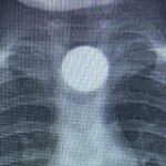 Bursa’da 3 yaşındaki Bilal’in yuttuğu madeni para, yemek borusunda kaldı