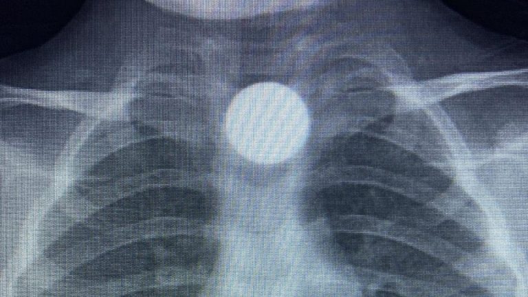 Bursa’da 3 yaşındaki Bilal’in yuttuğu madeni para, yemek borusunda kaldı