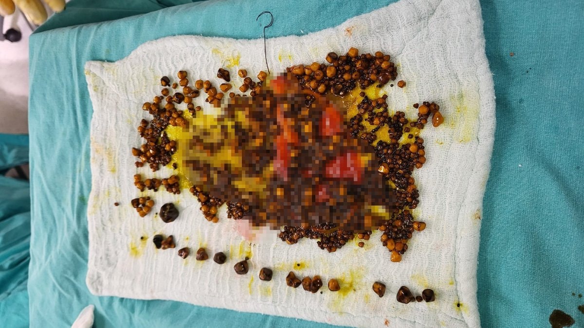 Manisa’da karın ağrısı şikayetiyle hastaneye giden kadının safra kesesinden binlerce taş çıktı