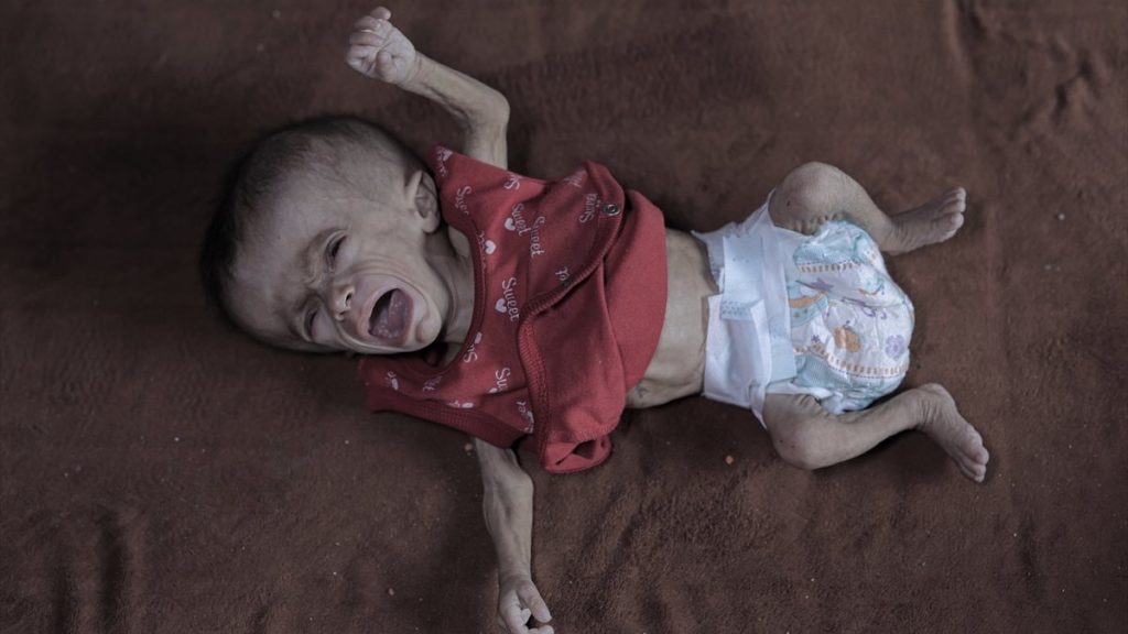 Gazze’de açlık: Filistinli bebeğin yaşam mücadelesi