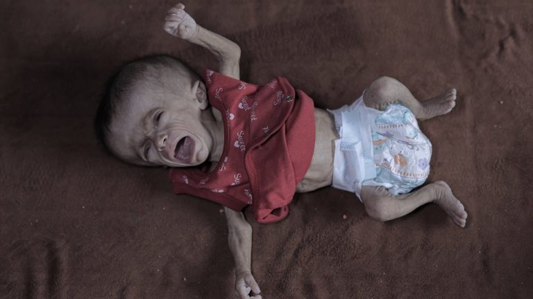 Gazze’de açlık: Filistinli bebeğin yaşam mücadelesi