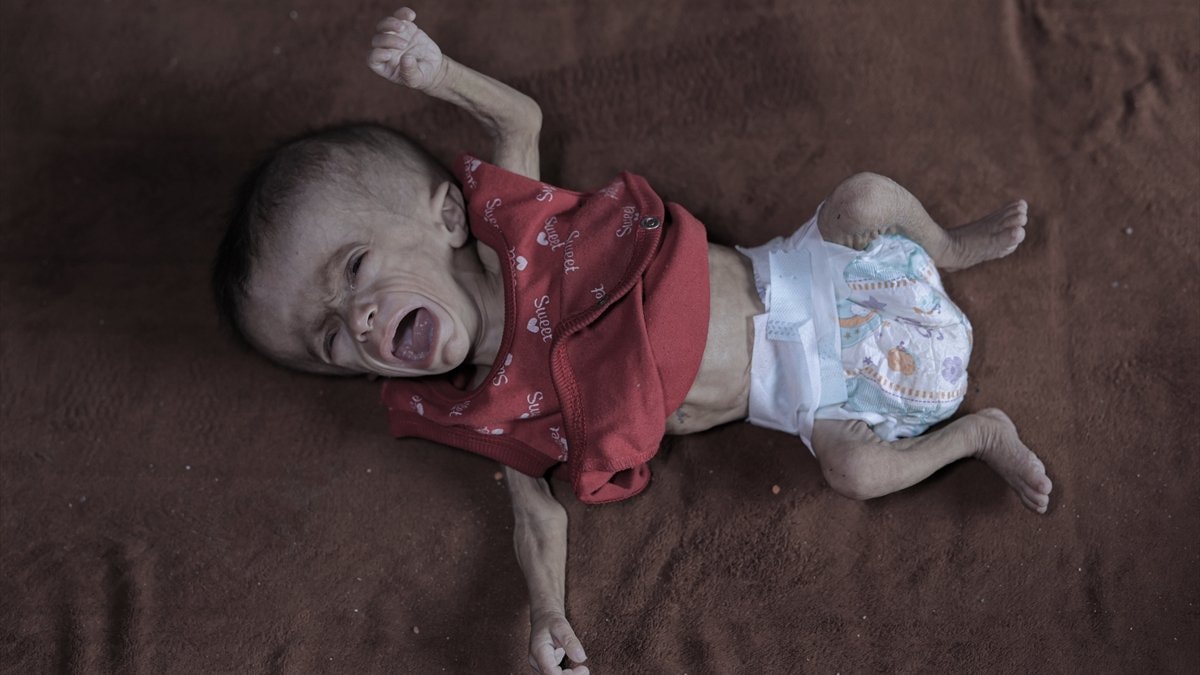 Gazze’de açlık: Filistinli bebeğin yaşam mücadelesi
